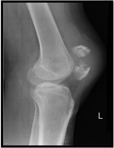 Case Report: Xsens motion analysis and virtual reality–based rehabilitation in a national-level badminton player following MPFL reinjury leading to postoperative patellar fracture