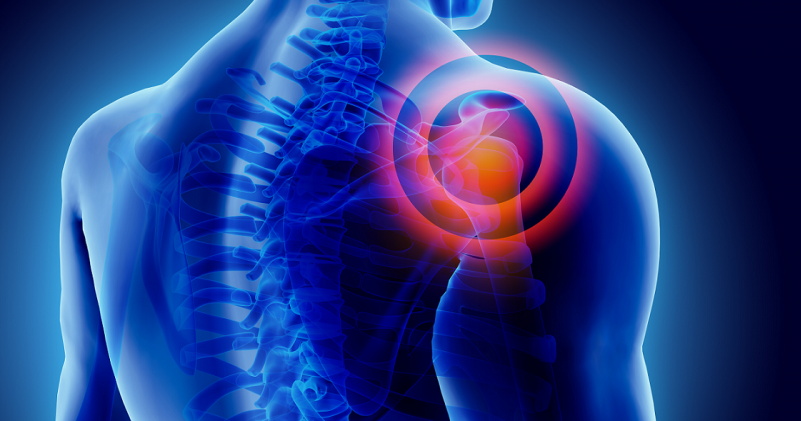 Wireless measurement of scapular dyskinesis with IMMS